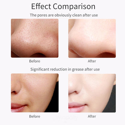 Ultrasonic Skin Scrubber Deep Pore & Blackhead Remover
